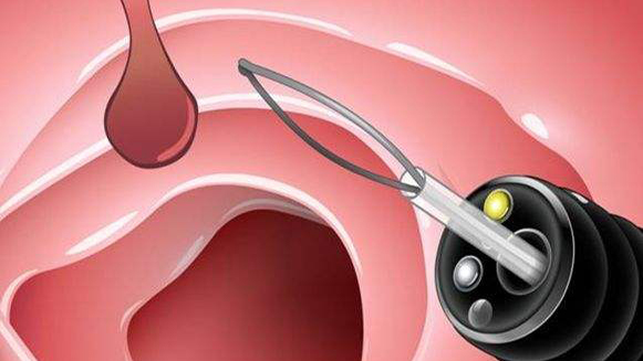 【健康解碼·小貼士】檢查出息肉 需要切除嗎？
